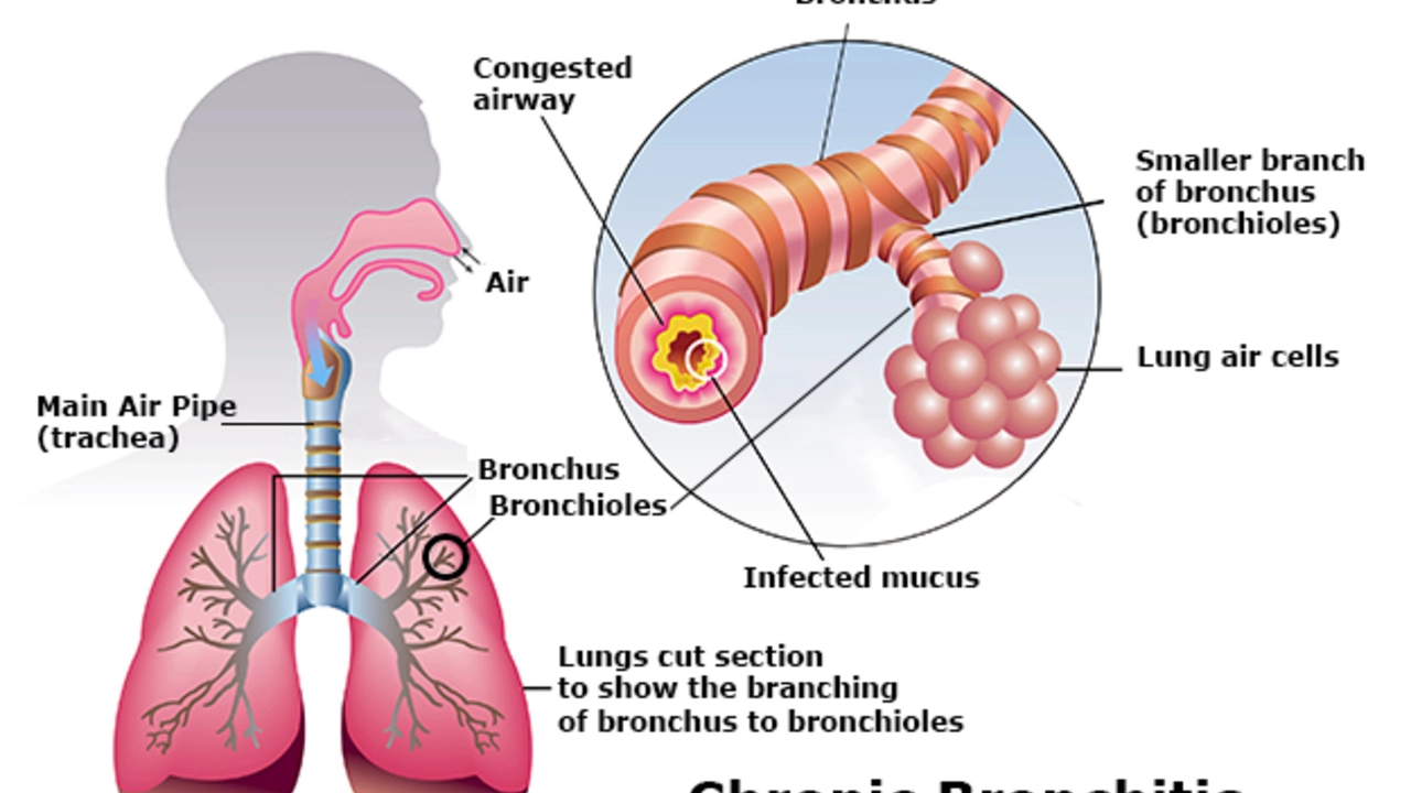 The role of Ofloxacin in treating bronchitis and pneumonia